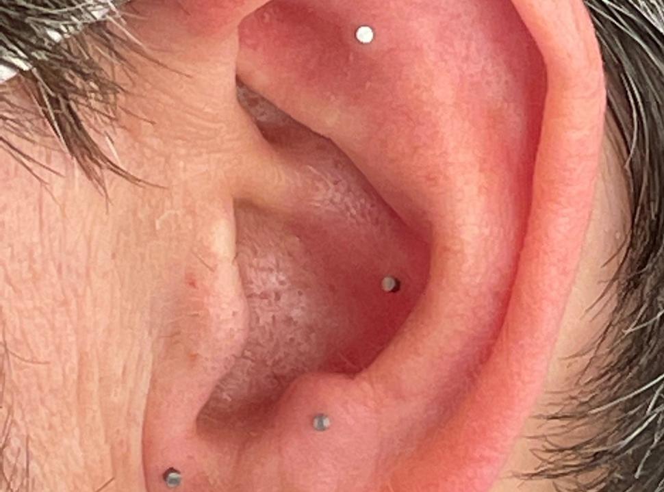 Can Acupuncture Help Cancer Survivors with Chronic Pain?